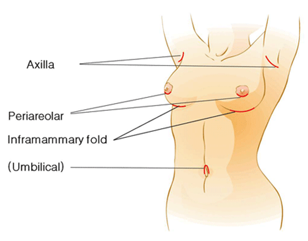 phẫu thuật nâng ngực có ảnh hưởng đến sinh con không