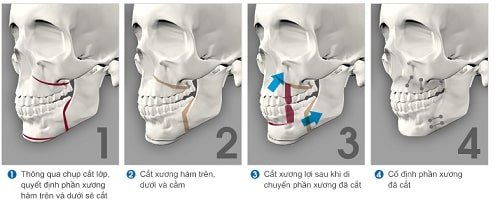 Phẫu thuật hàm hô móm kết hợp làm răng sứ 1
